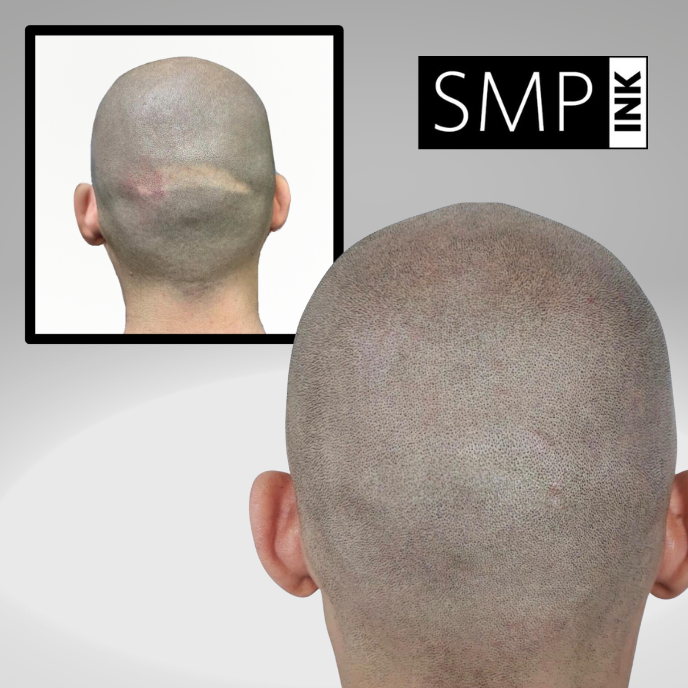 How to Prepare for Your Scalp Micropigmentation Appointment