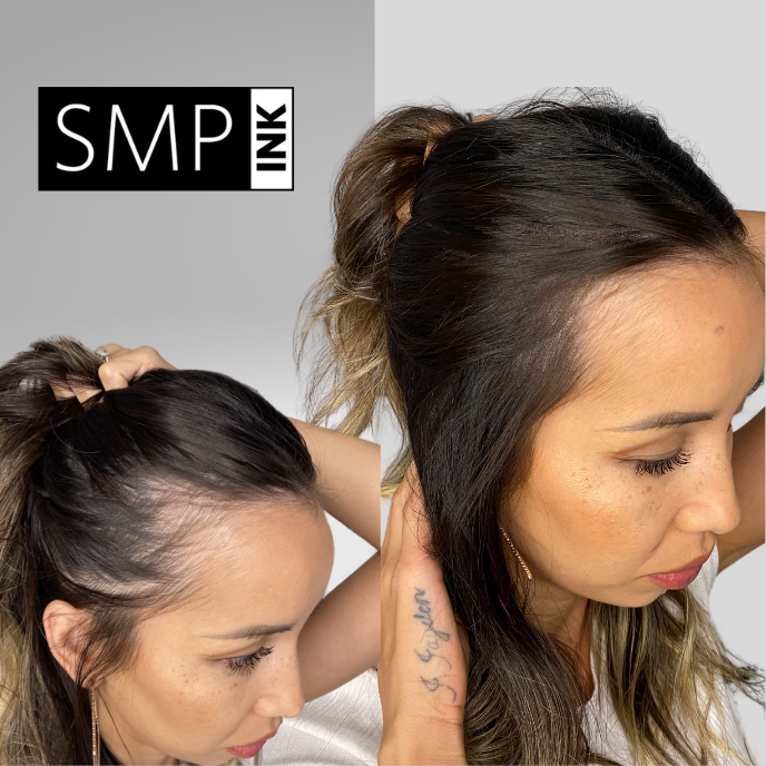 SMP for Thinning Hair: Enhancing Volume and Density