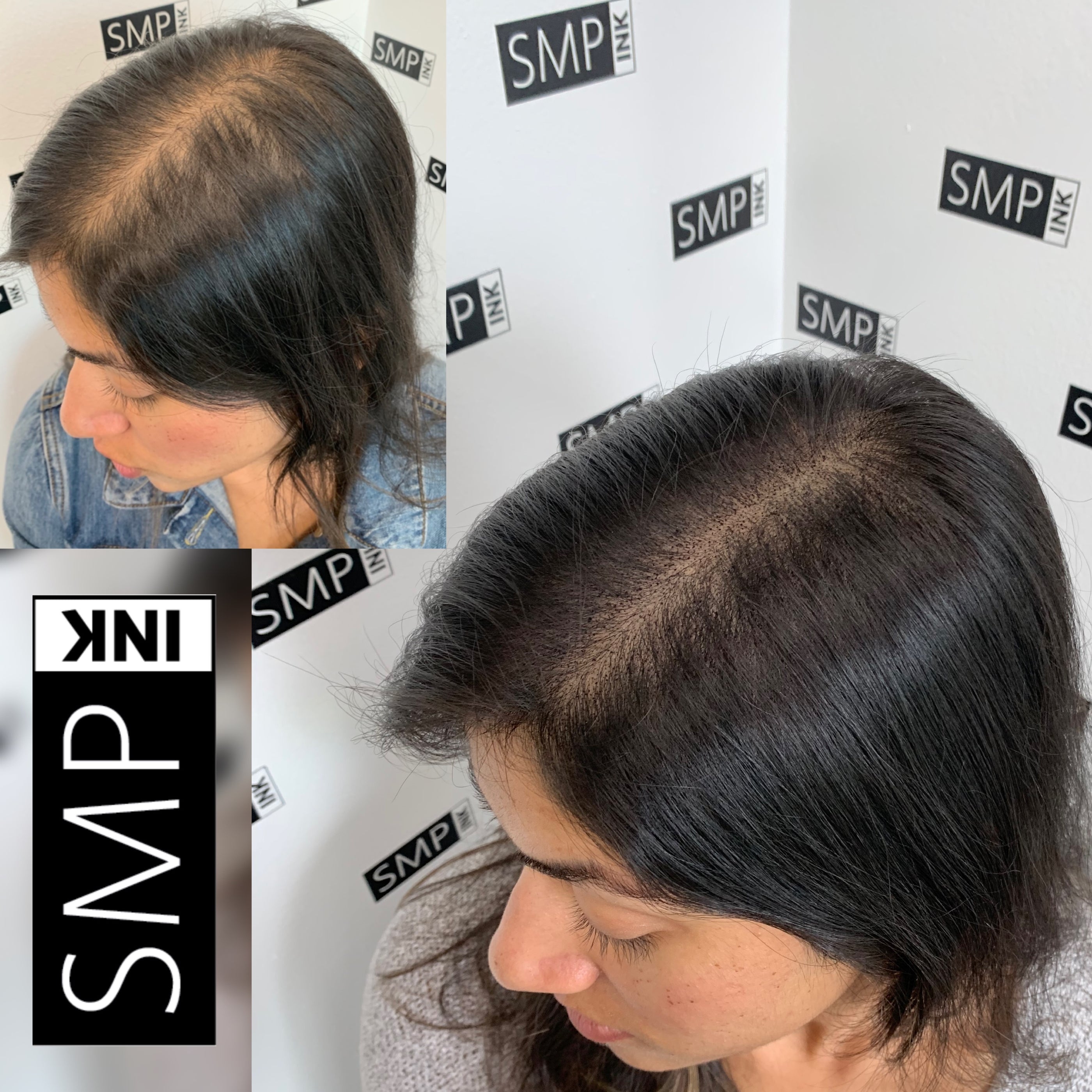 Scalp micropigmentation before and after for Women