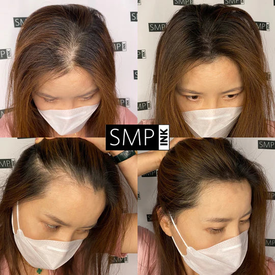 SMP for Women: Breaking the Stigma of Female Hair Loss