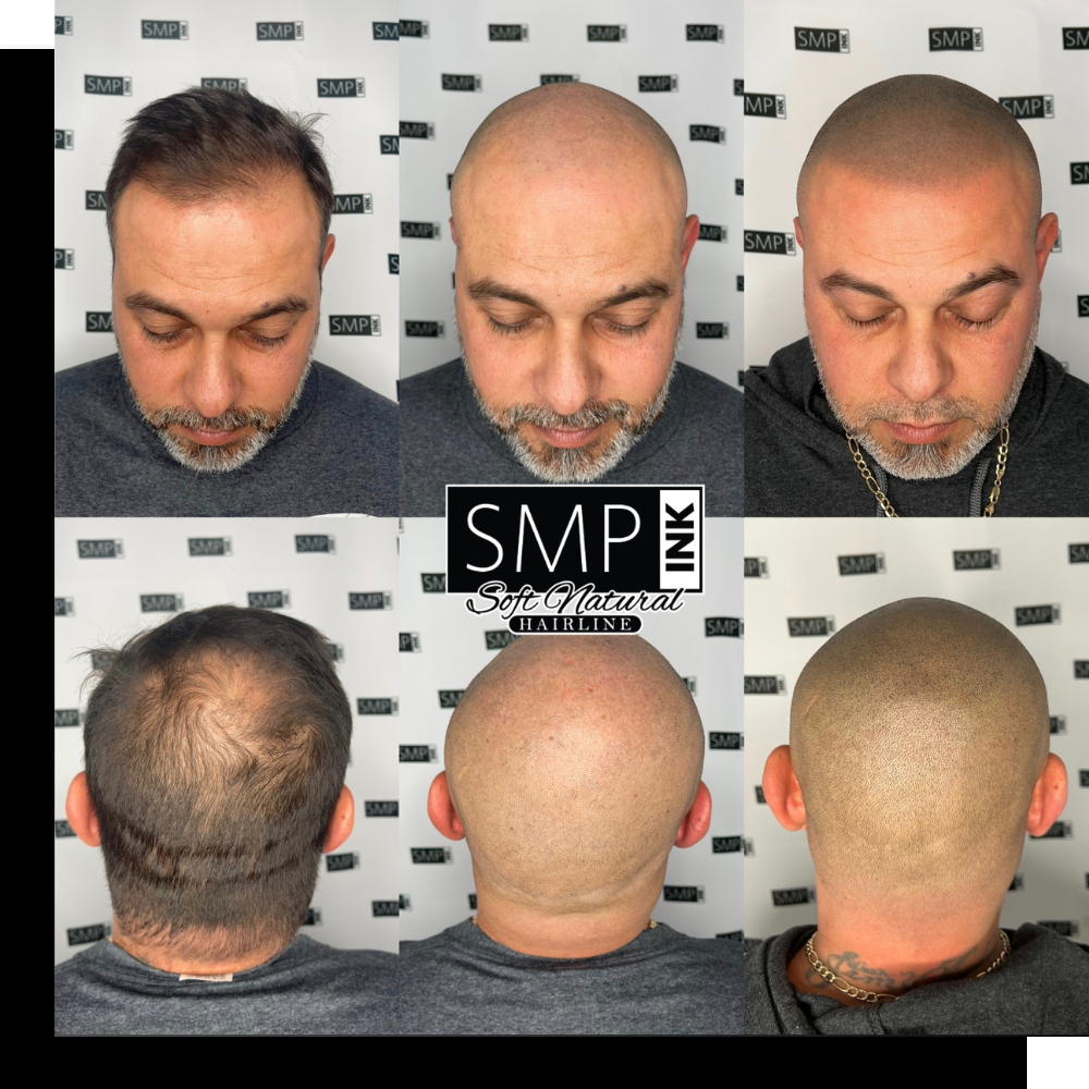 Maintaining a Healthy Scalp Post-SMP