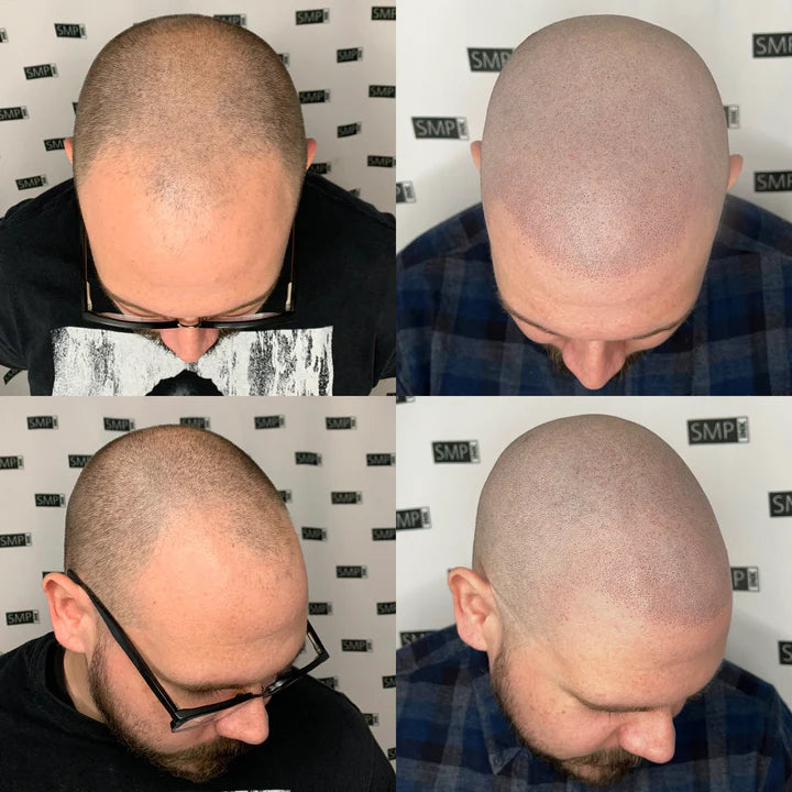 Scalp Micropigmentation Men Before and After