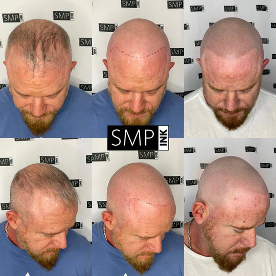 Scalp Micropigmentation for Men Before and After