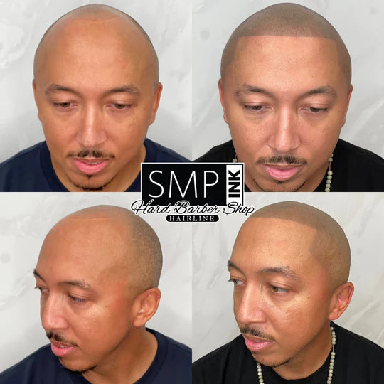 Scalp Micropigmentation for Men Before and After