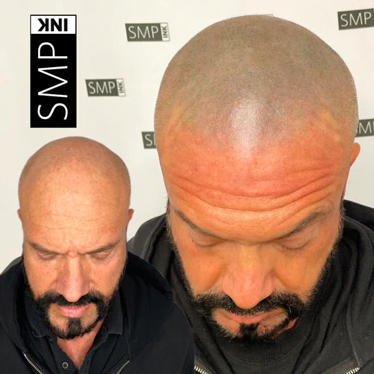 Scalp Micropigmentation for Men Before and After