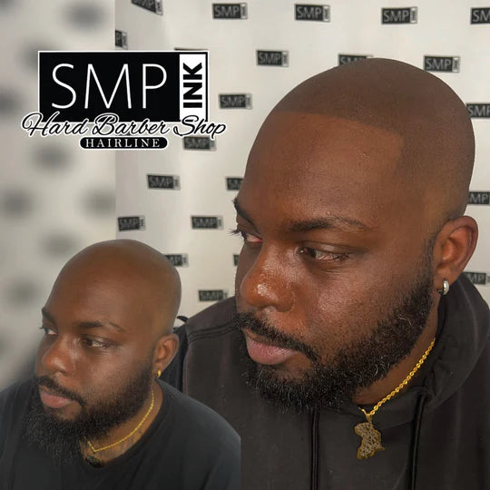 Scalp Micropigmentation for Men Before and After