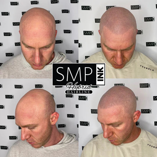 Scalp Micropigmentation for Men Before and After