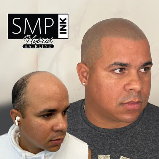 Scalp Micropigmentation for Men Before and After