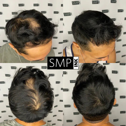 Scalp Micropigmentation for Men Before and After