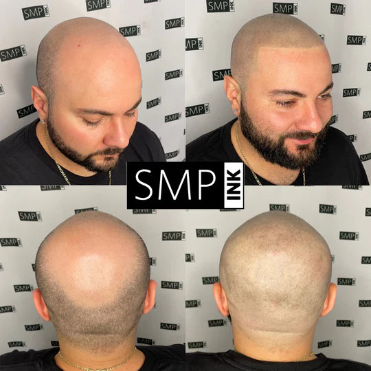 Scalp Micropigmentation for Men Before and After