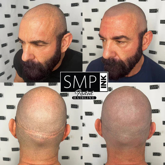 Scalp Micropigmentation SMP Ink Faded hairline/scar cover