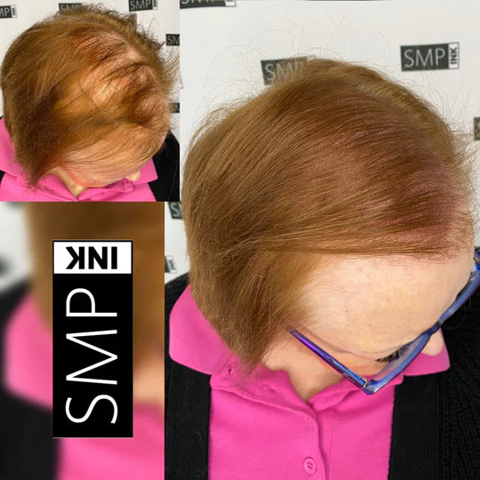 Women Scalp Micropigmentation Before and After