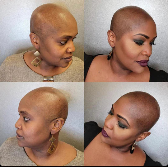 Women Scalp Micropigmentation Before and After