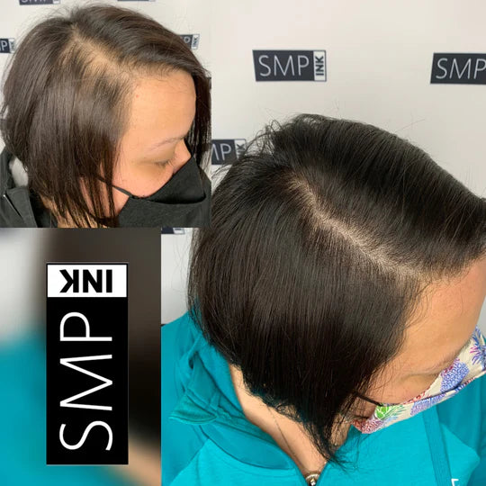 Women Scalp Micropigmentation Before and After