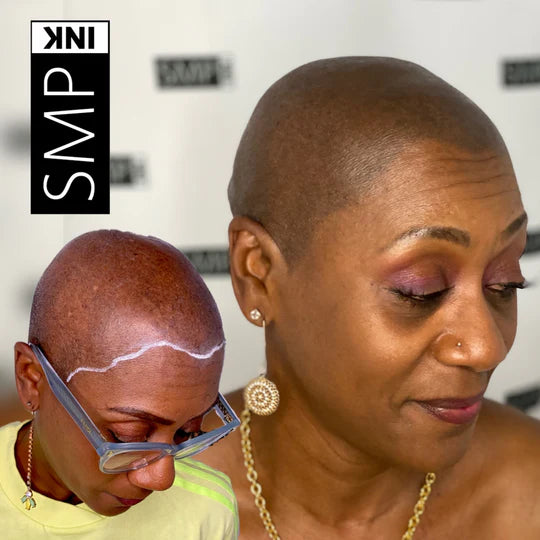 Women Scalp Micropigmentation Before and After 