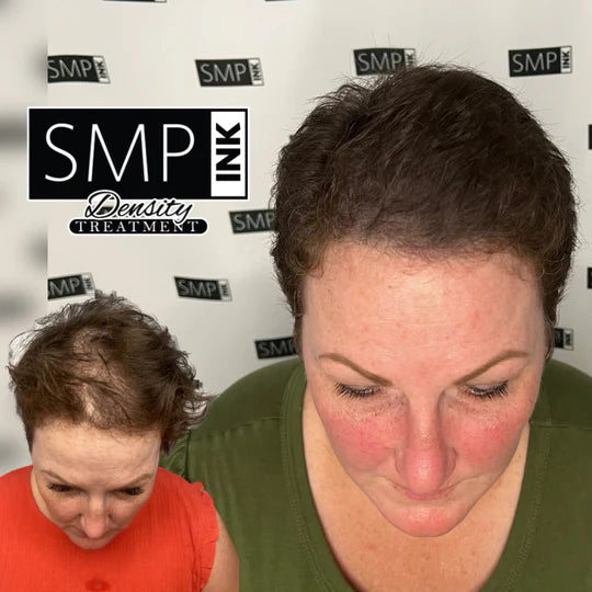 Women Scalp Micropigmentation Before and After