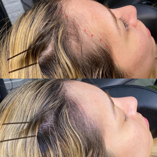 Women Scalp Micropigmentation Before and After