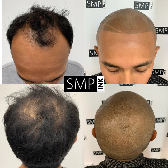 Scalp Micropigmentation for Men Before and After