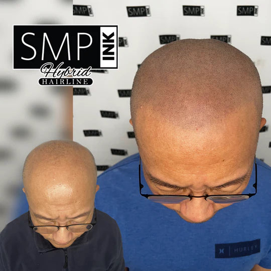 Scalp Micropigmentation for Men Before and After